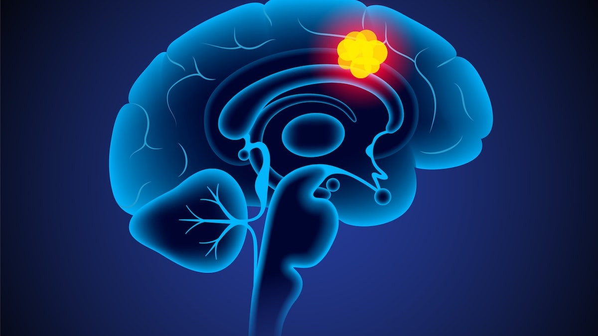 Brain cancer patients who received this pain medication lived longer, study shows  at george magazine