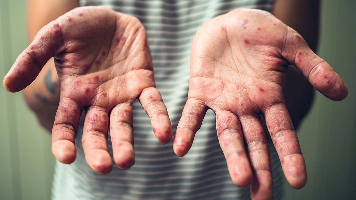 Highly contagious disease surges in some US states amid report of possible fatal case  at george magazine