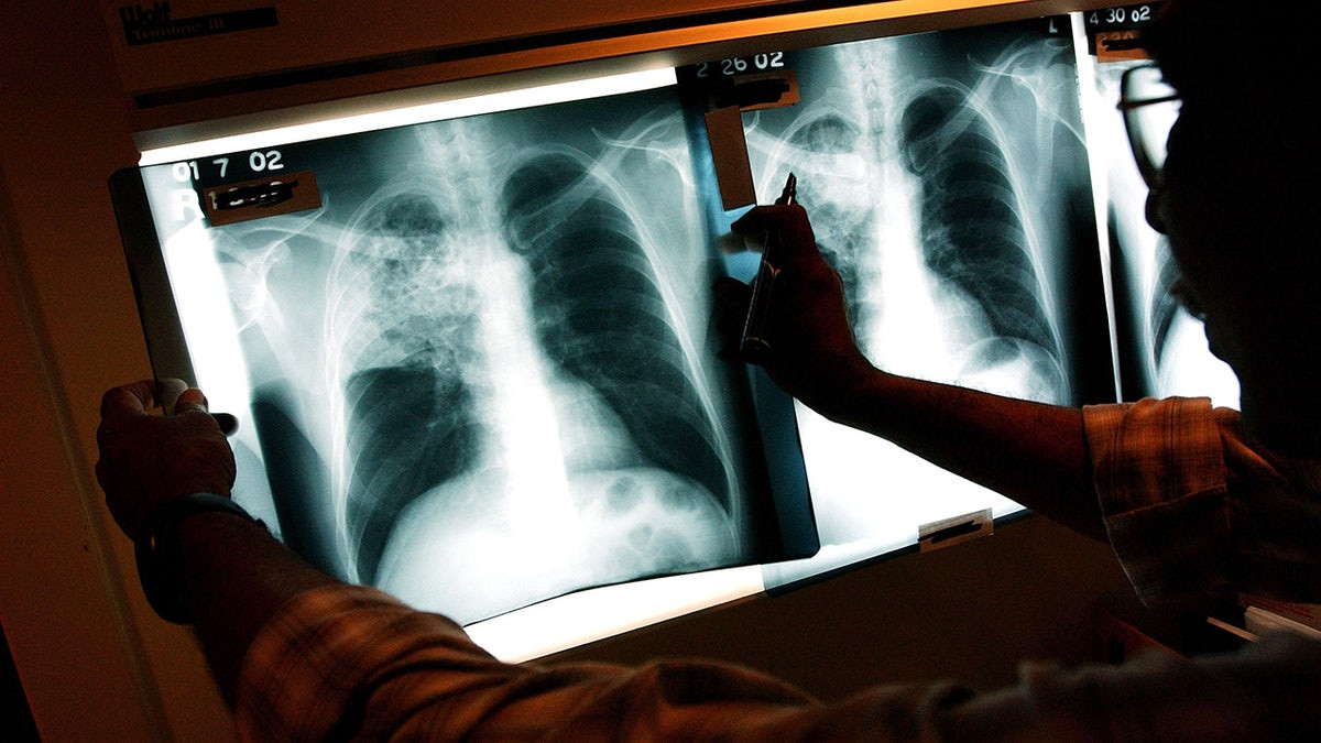 Three active tuberculosis cases reported in Maine as deadly disease continues to tick up across country  at george magazine
