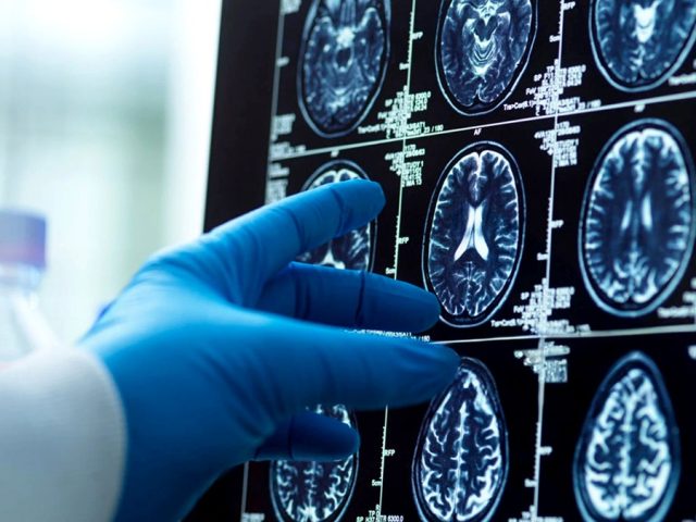 Men’s brains shrink faster than women’s; researchers explore Alzheimer’s connection