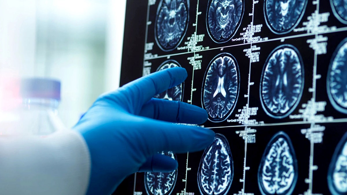 Men's brains shrink faster than women's; researchers explore Alzheimer's connection  at george magazine