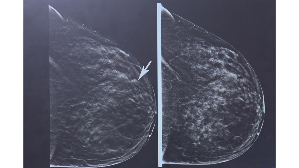 Stealth breast cancer that hides from scans targeted in breakthrough tech  at george magazine