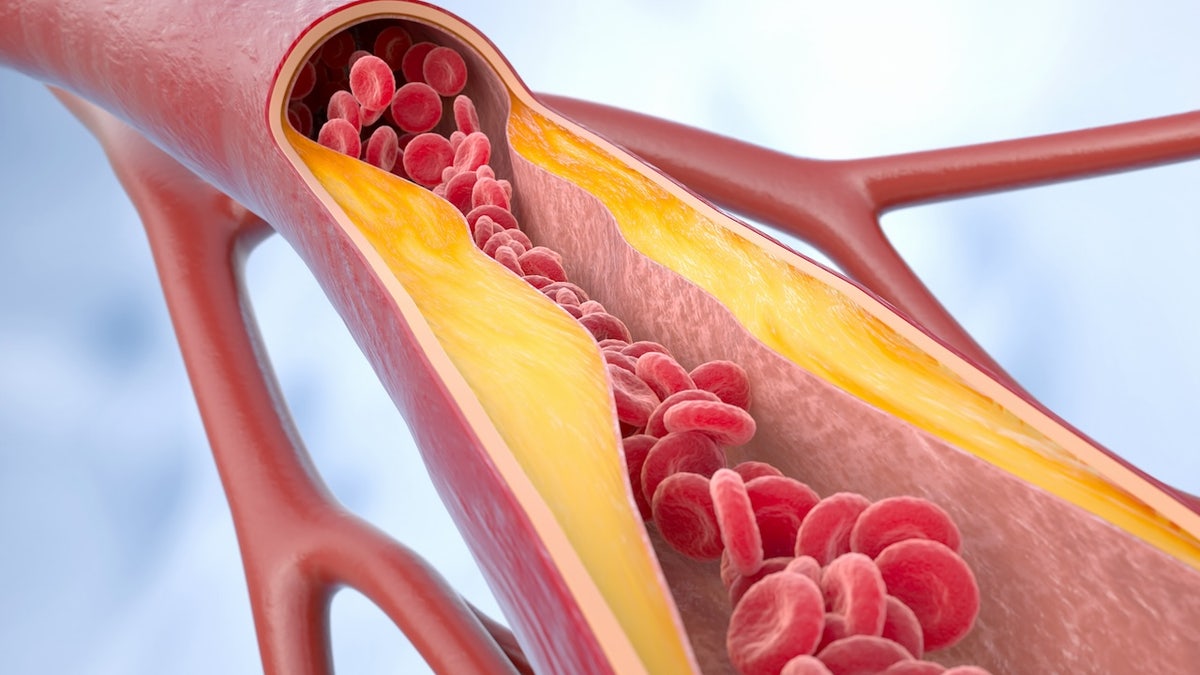 Daily pill slashes 'bad' cholesterol levels by 60% in yearlong trial  at george magazine