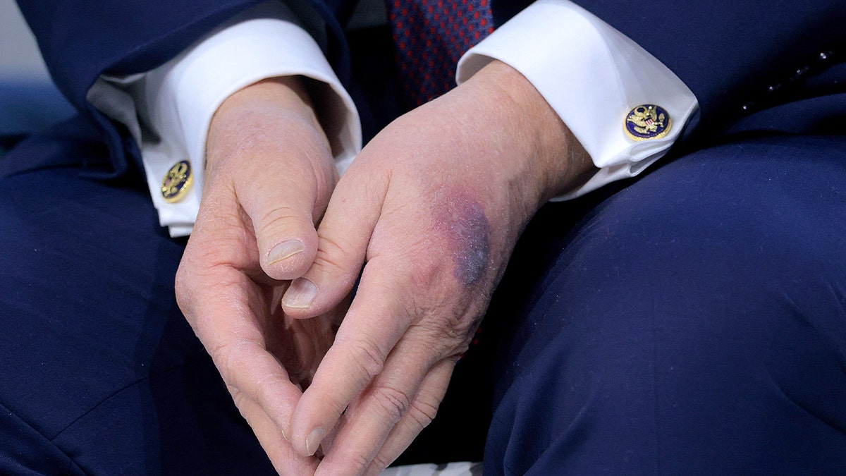 White House explains bruise on Trump's hand at george magazine