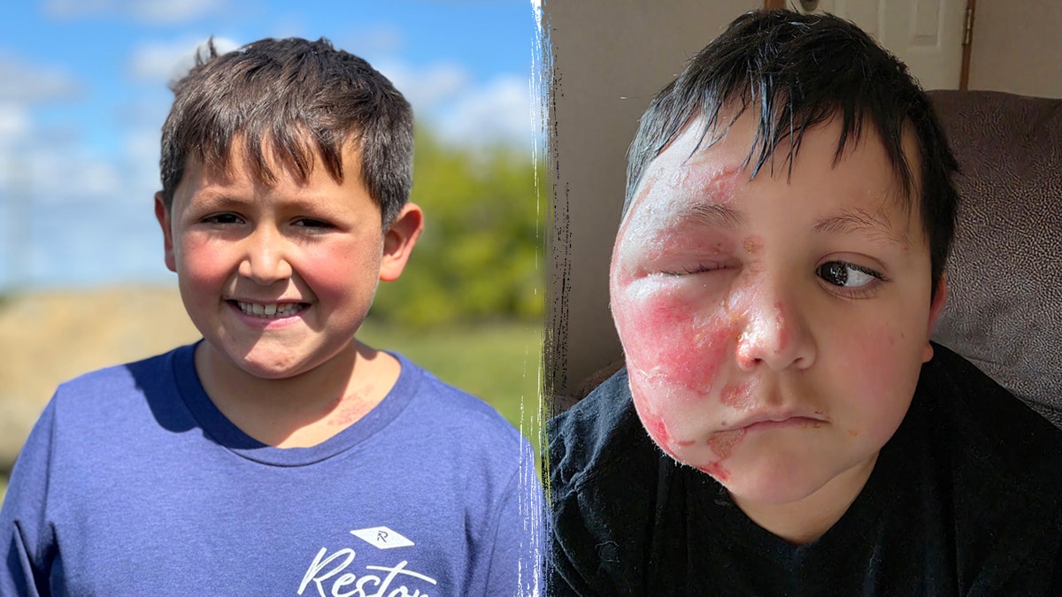 Dangerous TikTok trend leaves boy badly burned as doctors issue warning at george magazine