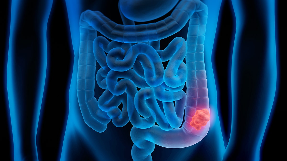 Hidden virus inside gut bacteria linked to doubled colorectal cancer risk, study finds at george magazine