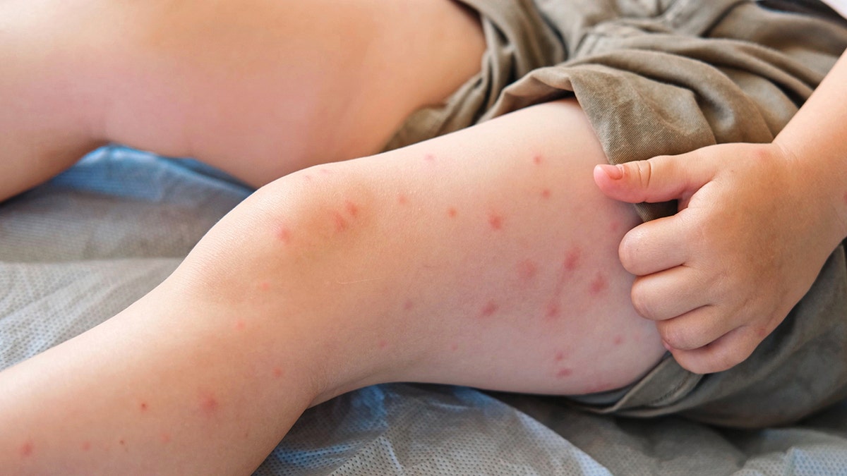 Measles outbreak poses risk of 'irreversible' brain damage, health officials warn at george magazine