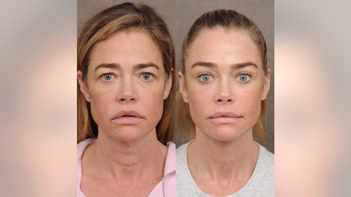 Denise Richards debuts ‘shocking’ facelift transformation in before-and-after photos at george magazine