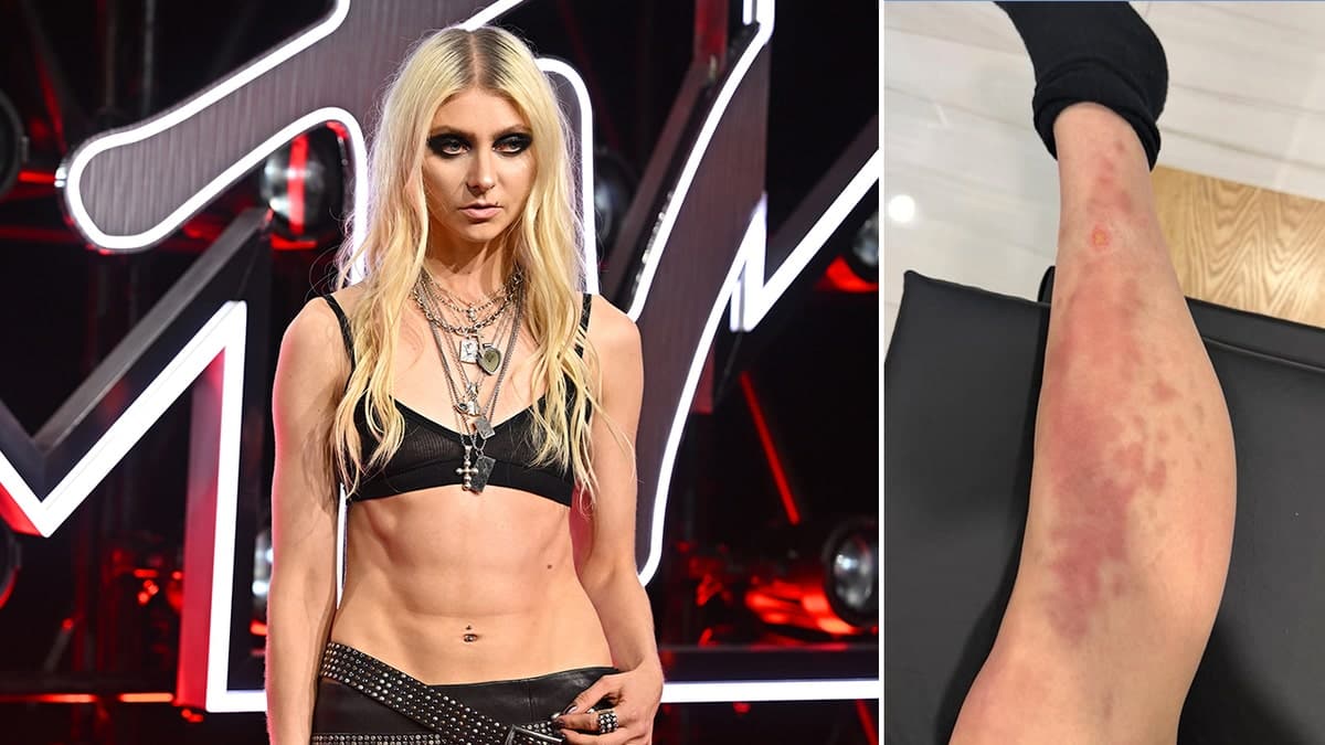 Taylor Momsen has a spider bite