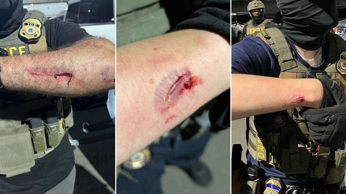 Immigration agents display bloody wounds with bite marks