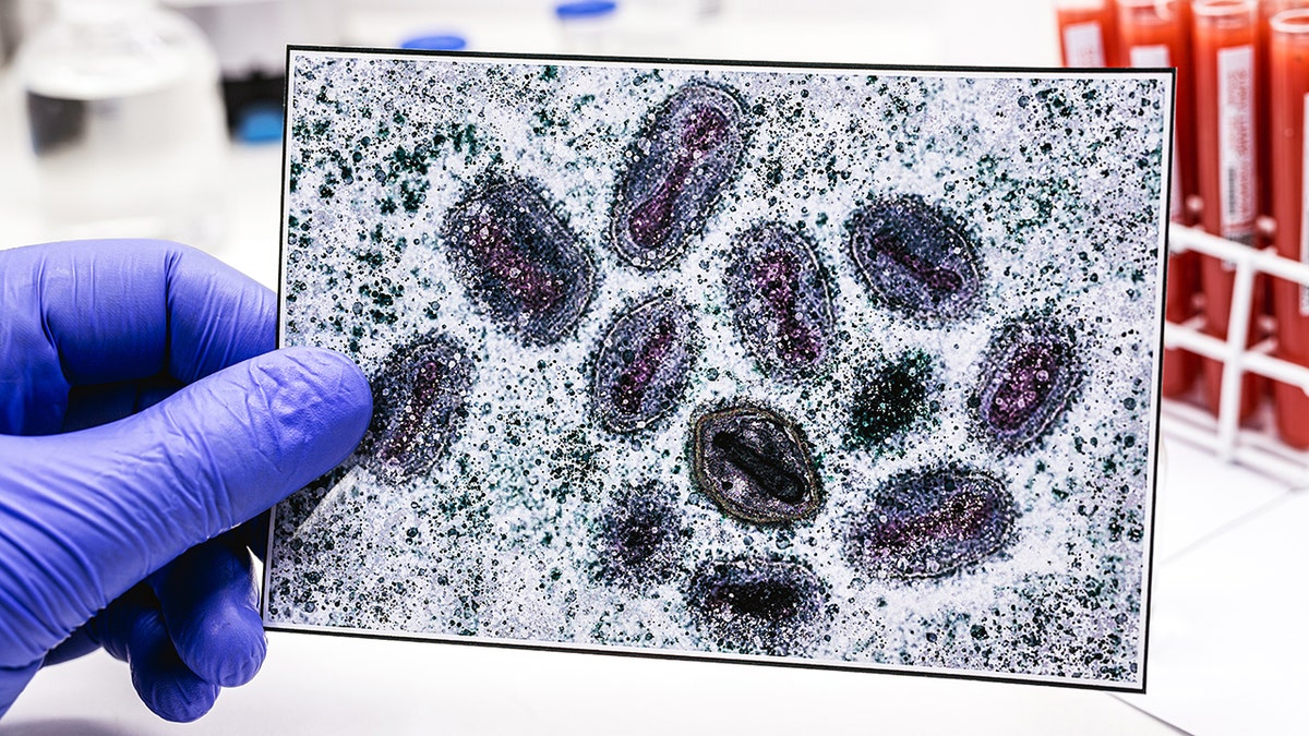 Pharmacist's hand wearing latex glove holding a photo of monkeypox virus