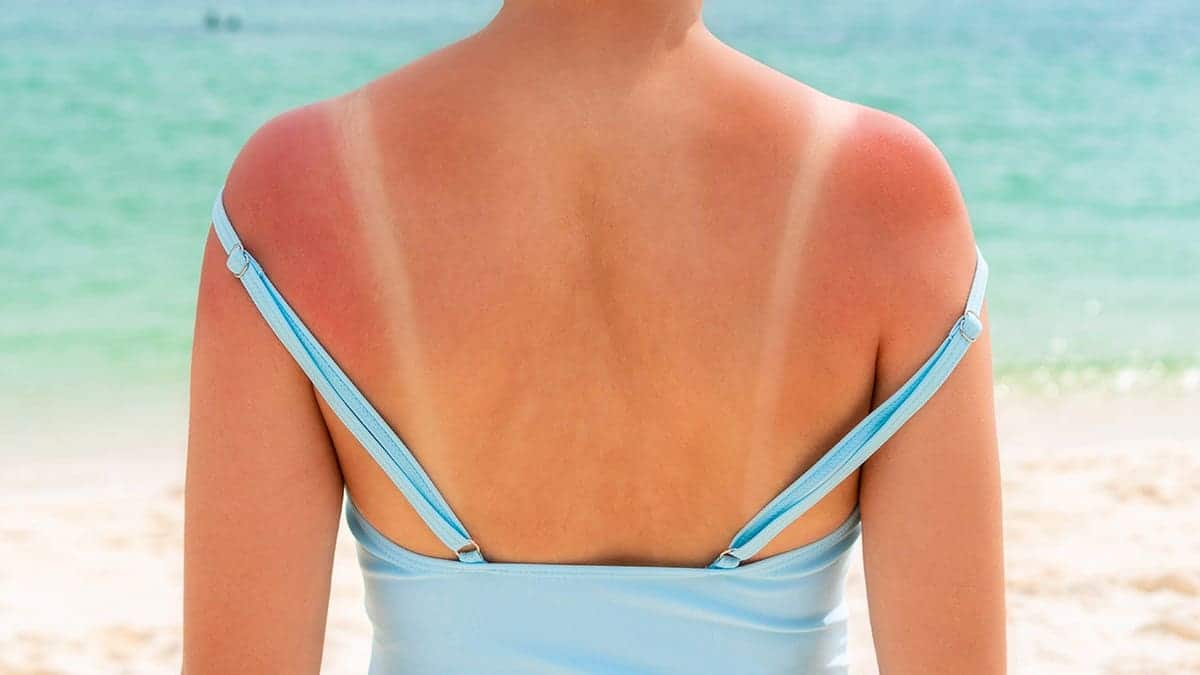 sunburned shoulders